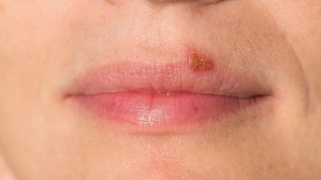 Complicaciones Del Herpes Labial En Verano Como Prevenirlo