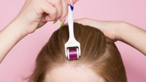 Microneedling capilar para estimular la regeneración del cabello